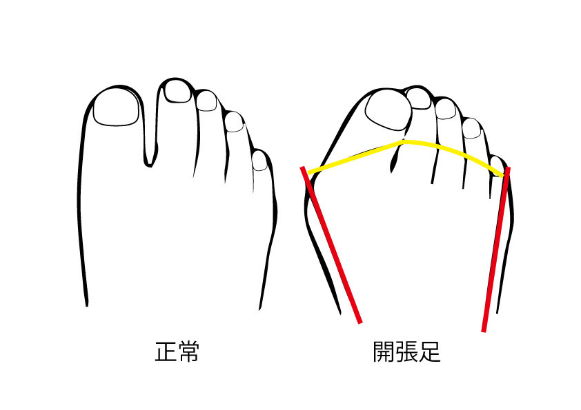 開張足とは 革靴のサイズ選びを間違えると起こる足の現代病を知る Sot ソット 公式サイト オンラインストア