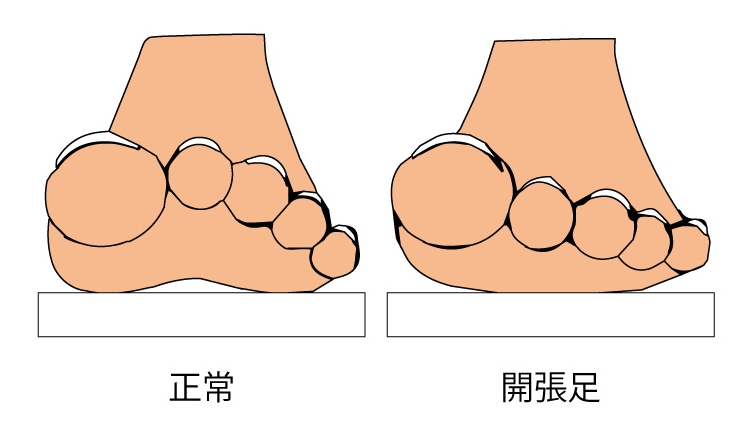 開張足とは 革靴のサイズ選びを間違えると起こる足の現代病を知る Sot ソット 公式サイト オンラインストア